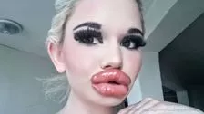 More than 20 injections: Are these the world's thickest lips?