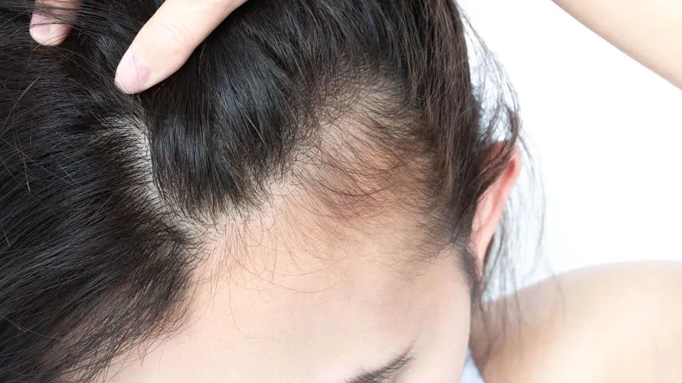 Receding hairline in women: SOS tips for hair loss