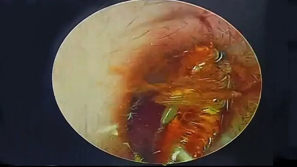 Formicolio all'orecchio: il medico estrae uno scarafaggio dal condotto uditivo