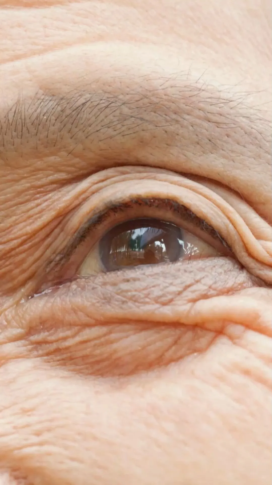 Tränensäcke: Tipps und Hausmittel gegen die Schwellung unterm Auge